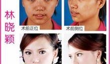 微整形隆鼻最新爆料视频,网红爆料视频大揭秘